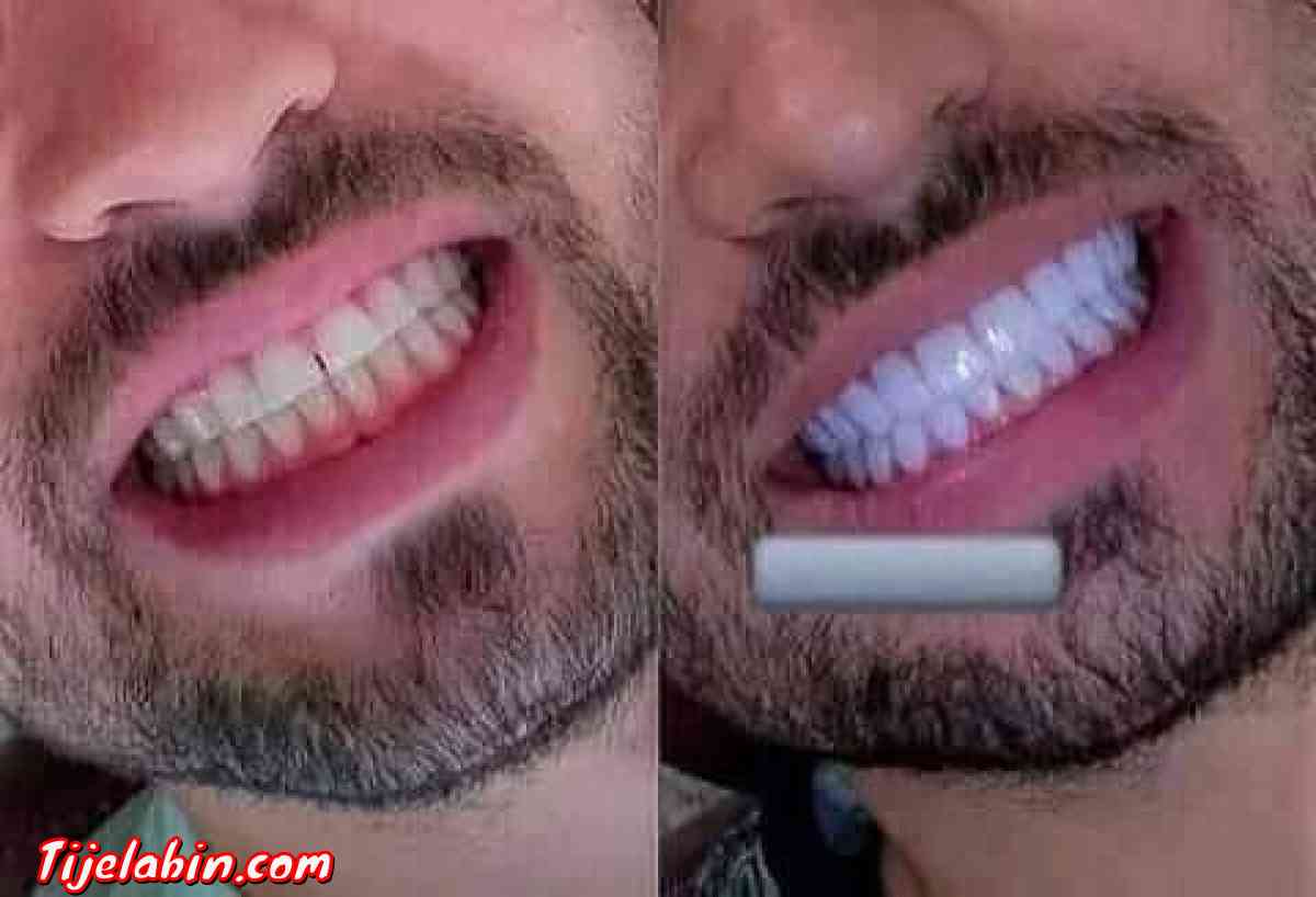 مبيض الاسنان - Alger Centre, Alger - Tijelabin